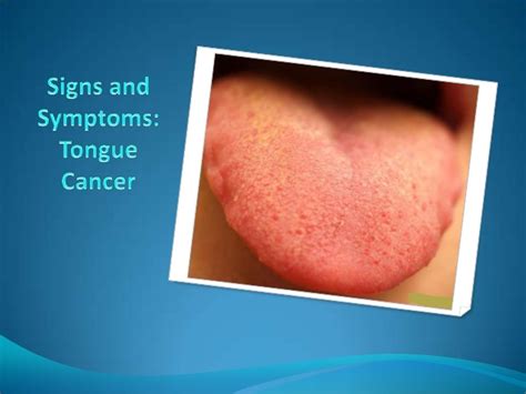 Signs and symptoms tongue cancer