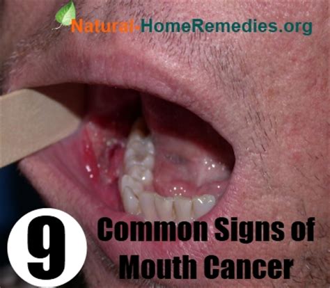 Signs Of Mouth Cancer   How To Recognize The Signs Of ...