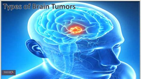 Signs, Symptoms and Types of brain tumors