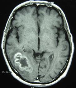 Síndrome de Guillain Barré tras resección de glioblastoma ...