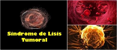 Síndrome de Lisis Tumoral: Definición, Síntomas, Causas ...