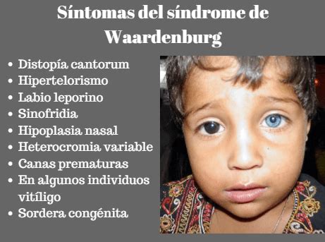 Síndrome de Waardenburg: Síntomas, Causas, Tratamiento ...