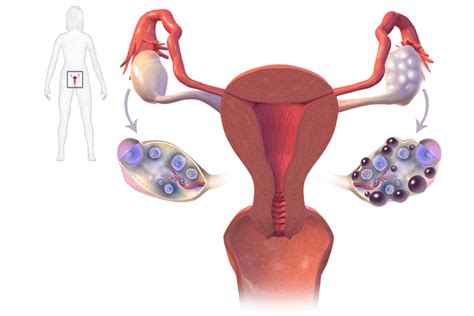 Síndrome del Ovario Poliquístico | Guía práctica【2020】