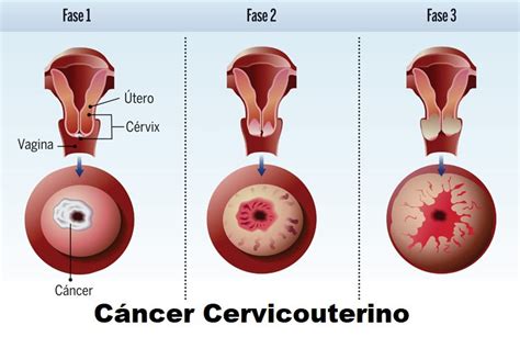 Sintomas Cancer Cervicouterino | Healthy HesongBai