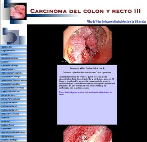 Sintomas Cancer De Colon Avanzado   SEONegativo.com