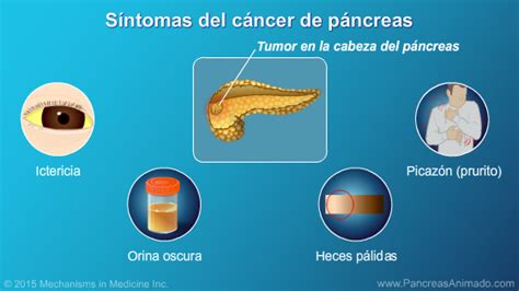 Sintomas Cancer De Pancreas   SEONegativo.com