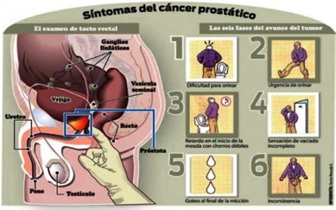 Sintomas Cancer De Prostata   SEONegativo.com
