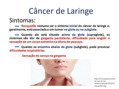 Sintomas Cancer Garganta
