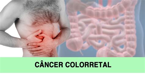 Sintomas de cancer de colon rectal, Cancer de colon quais ...