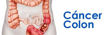 Síntomas de cáncer de colon ⊛ ¡Prevención y Tratamiento 2019!