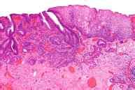 Síntomas de cáncer de esófago  esofágico : primeros ...