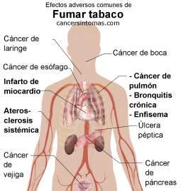 Síntomas de cáncer de esófago  esofágico : primeros ...