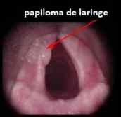 Síntomas de cáncer de garganta  laringe : primeros ...