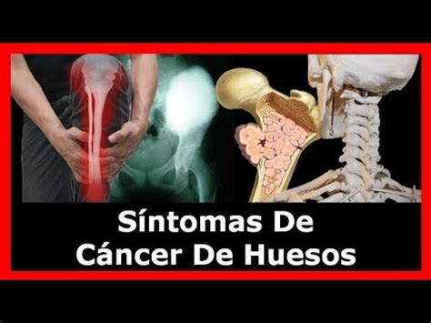 Sintomas De Cancer De Huesos   YouTube