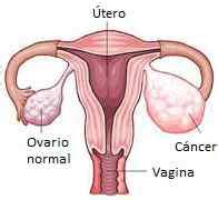 Síntomas de cáncer de ovario: primeros, iniciales y avanzado
