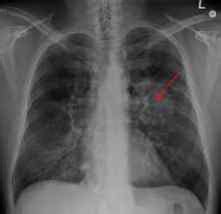 Síntomas de cáncer de pulmón  pulmonar : primeros ...