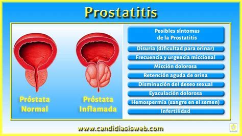 Sintomas De La Prostata Inflamada   SEO POSITIVO