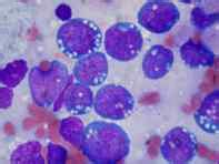 Síntomas de linfoma no Hodgkin  folicular, Burkitt  y ...