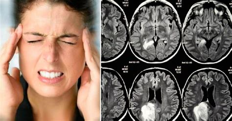 Sintomas de tumor cerebral que jamais devemos ignorar