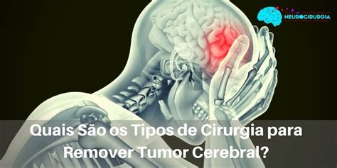 Sintomas de Tumor Cerebral   Saiba Mais | Dr Victor Barboza
