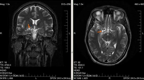 sintomas de tumor cerebral   Tratamiento y Enfermedades