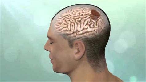 Síntomas de un tumor en el cerebro: Todo lo que debes saber