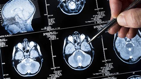 Síntomas de un tumor en el cerebro: Todo lo que debes saber