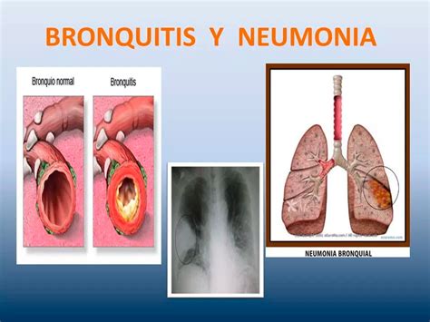Síntomas de una bronquitis o neumonía ¡Más información!
