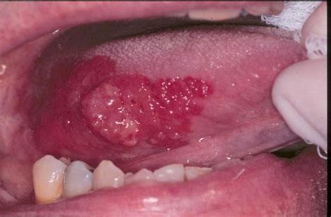 Síntomas del Cáncer Bucal por VPH Síntomas de Cáncer
