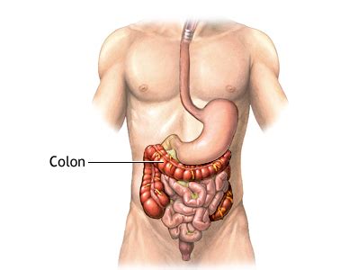 Síntomas del cáncer de colon   Cáncer de colon