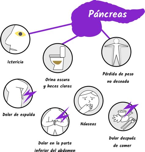 Síntomas del cáncer de páncreas   El control del cáncer de ...