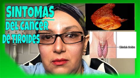 Sintomas del cancer de tiroides en la mujer   YouTube