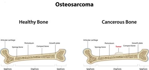Síntomas del cáncer óseo primario que debes conocer