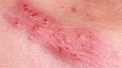 Síntomas del herpes anal: Una enfermedad que se lleva para ...