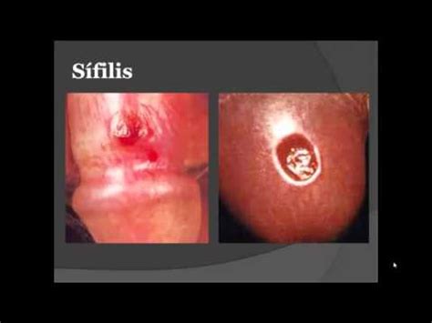 Sintomas del Herpes genital, Sifilis y Gonorrea   YouTube