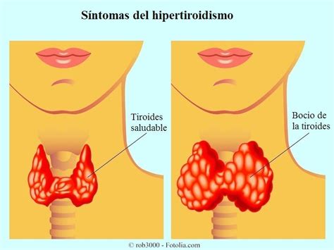 Síntomas del hipertiroidismo, hombres, mujeres, causas ...