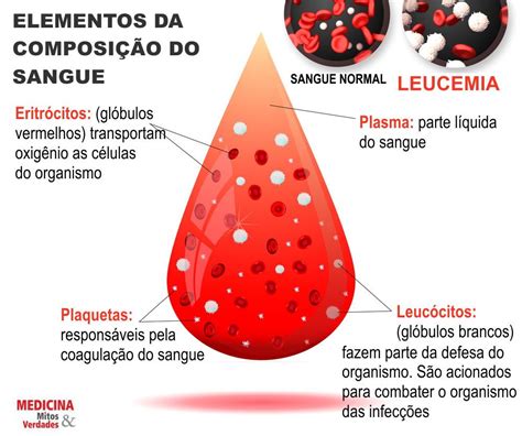 Sintomas Do Leucemia Câncer No Sangue