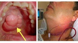 Síntomas iniciales en el cáncer de garganta o laringe