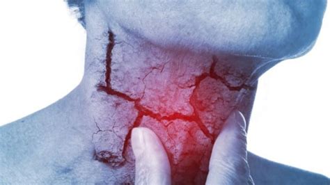 Síntomas más comunes del cáncer de garganta   Terra Chile