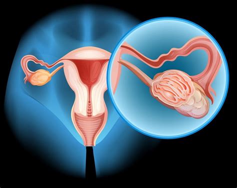 Síntomas que alertan el cáncer de ovario | YVKE Mundial