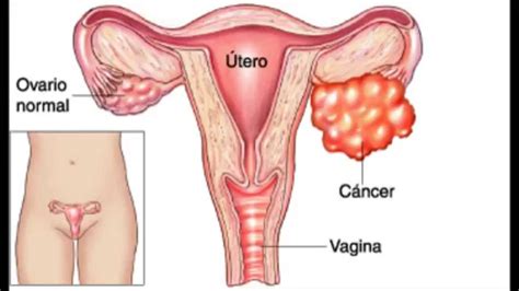 Sintomas tempranos de cáncer de ovario que no debes ...