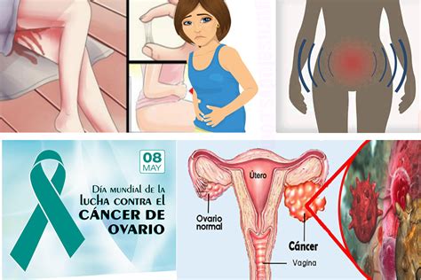 síntomas y signos del cáncer de ovario | Guru Saludvs ...