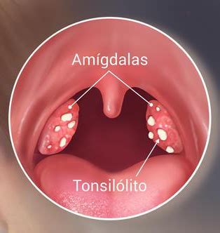 Síntomas y tratamientos del cáncer oral   Dentaltix