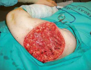 Siringoma condroide maligno: a propósito de un caso