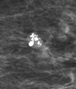 Sistema BI RADS ¿Cómo se interpreta una mamografía? | Ondas y Partículas