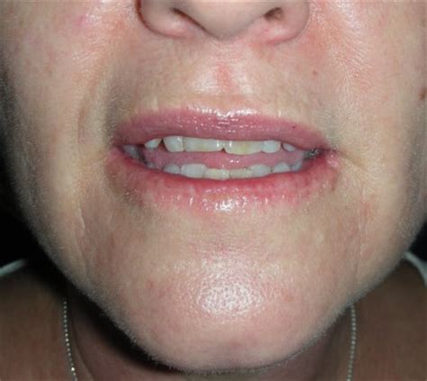 Skin Cancer Lower Lip – Lower Vermillionectomy