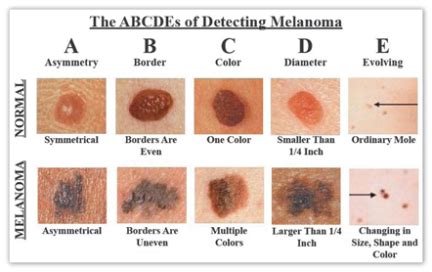 Skin cancer | Lupo Center for Aesthetic & General Dermatology