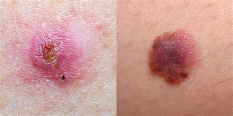 Skin Cancer Pictures 5 Different Types of Skin Cancer to ...