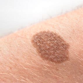 Skin Cancer Pictures & Facts: What You Need to Know