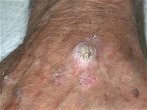 Skin Cancer Pictures, Melanoma Photos   Brandon, FL ...
